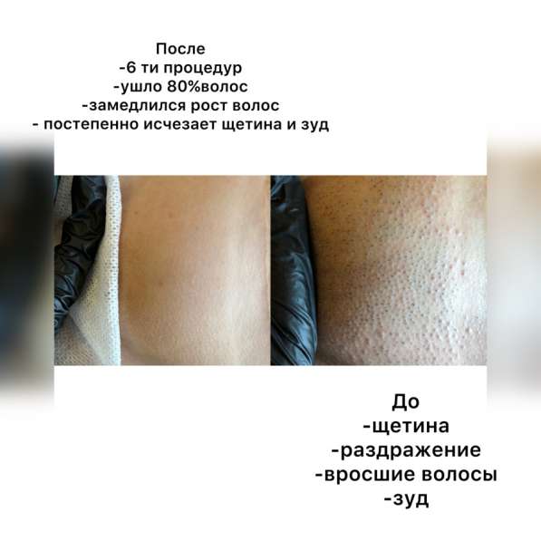 Лазерная эпиляция в Гуково фото 3