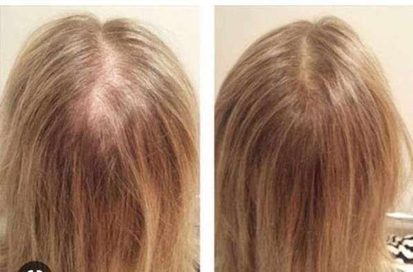 Мезотерапия волос от выпадения